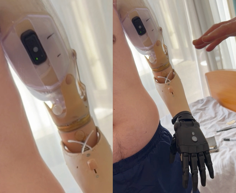 Person with above-elbow limb difference wearing a prosthetic arm