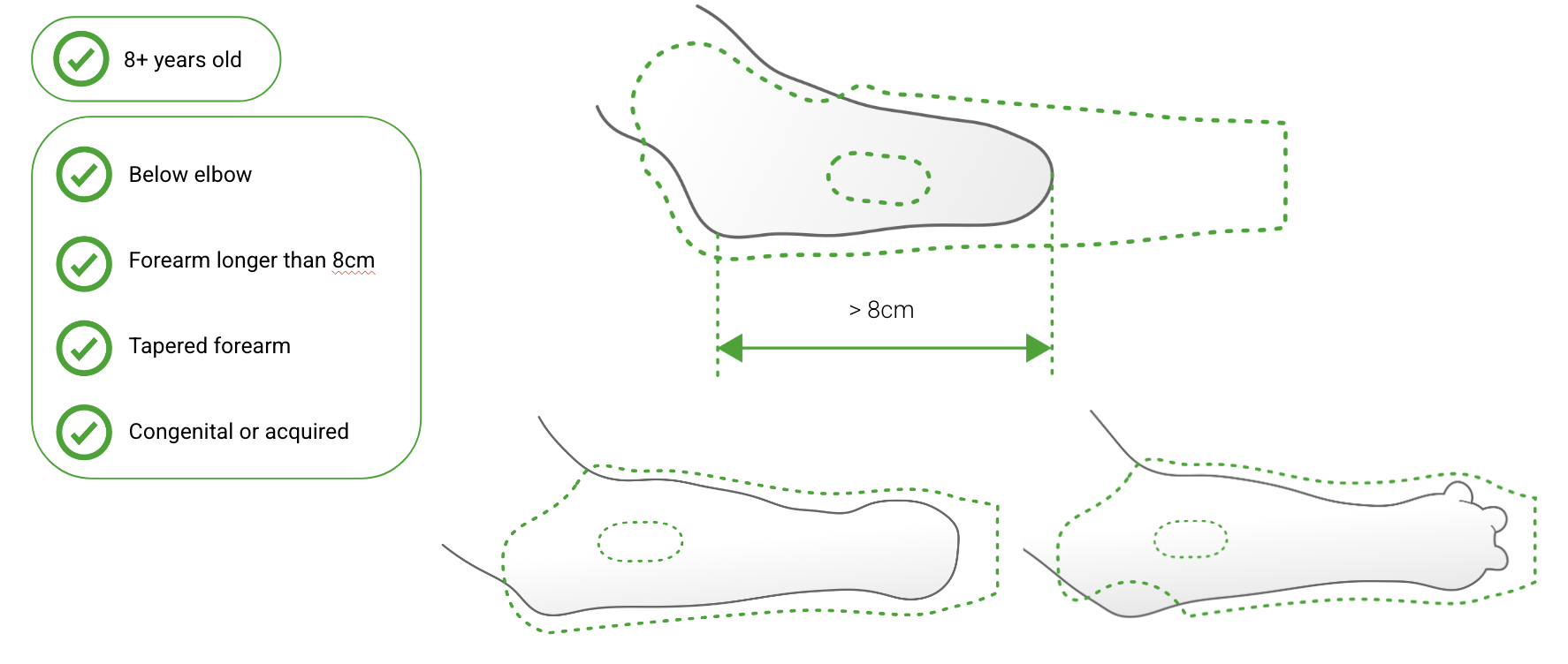 Diagram showing below elbow and above elbow limb difference levels
